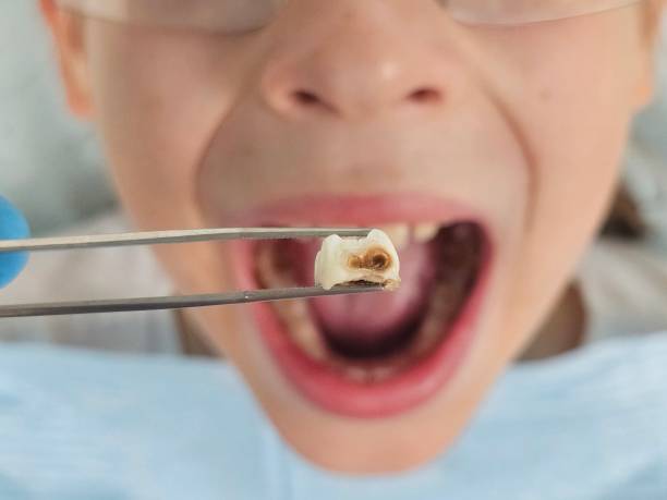Best Urgent Tooth Repair  in Mshall, AR